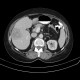 Liver metastasis, RFA, radiofrequency ablation of metastasis, before: CT - Computed tomography